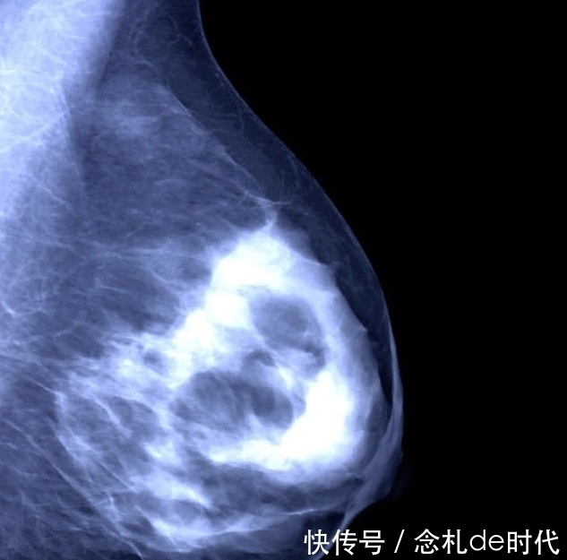 患者|一种提高晚期乳腺癌患者生存率的疗法:激素+瑞博西尼