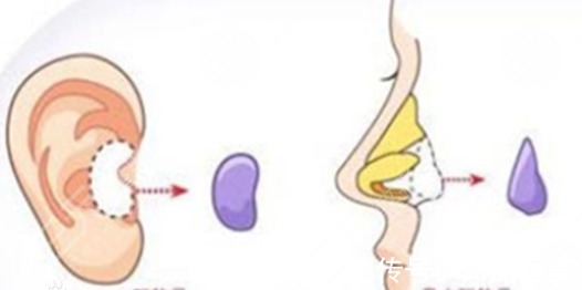 攻略 美鼻攻略|耳软骨隆鼻恢复期多久?注意事项+术后护理盘点!