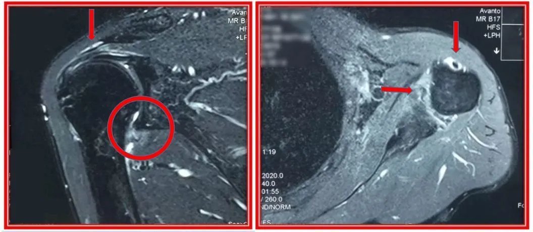 钙化性肌腱炎|长在肩膀上的“结石”:6旬阿姨肩膀半夜痛醒误以为肩周炎,原来是肩袖钙化性肌腱炎