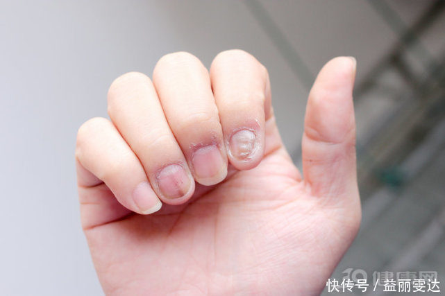 脚趾甲往肉里长?只要一根棉签,让嵌甲不再找你麻烦!