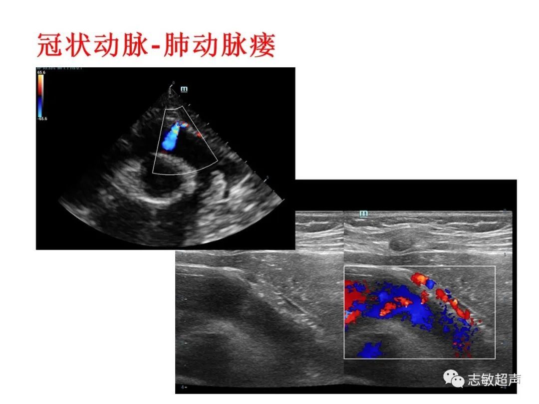 超声|肺动脉瓣周边异常血流的超声鉴别