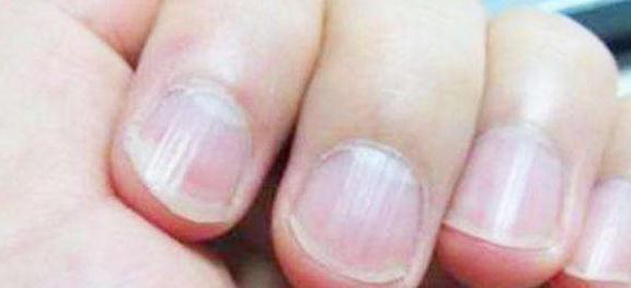 手指甲|不论男女,手指甲有竖纹多吃它,补钙补气血,晚上不失眠
