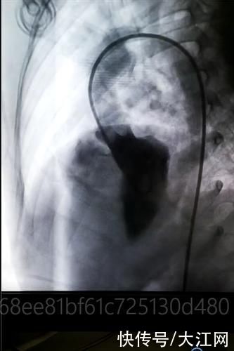 程应樟|「护心佑民」南大二附院程应樟教授团队为免费救治的先心病姐弟成功实施介入手术