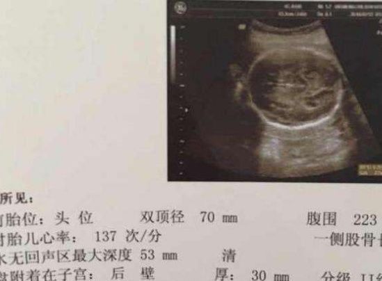 孕妈|孕期，若是怀了“小王子”，孕妈产检单上可能会出现3个“数据”
