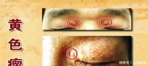 高血脂|中医院士1个食疗方,开水里放1物,血管干净、高血脂降了