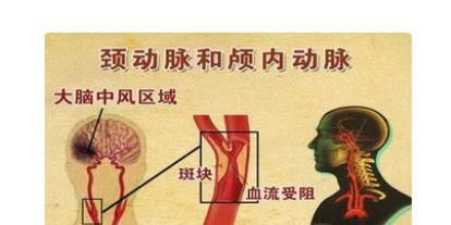 他汀|高血压合并颈动脉斑块患者，需要吃他汀和阿司匹林吗？