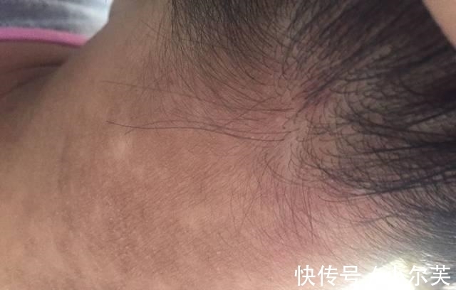 家长|9岁小女孩脖颈发黑洗不掉，经医院检查后，医生的话却让家长笑了