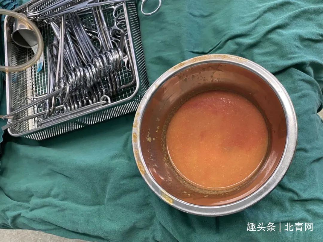 皮下组织|女子胸部取出200ml“鱼卵”！医生提醒未婚未育女性莫轻率尝试