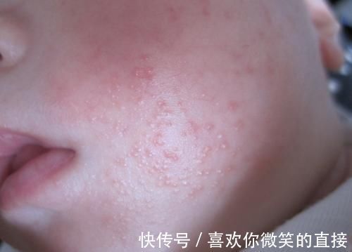 海鲜|提醒宝妈:这2种食物,容易诱发湿疹上身,别再给孩子吃了