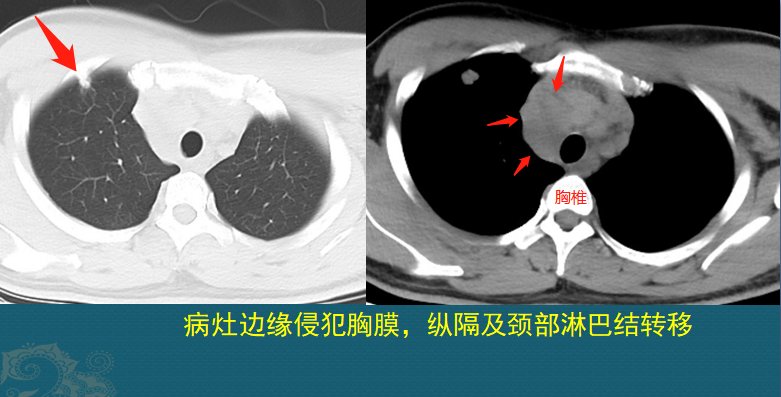 肺鳞癌|肺癌复发和转移的原因是什么？医生用2个病例，指导正确防癌