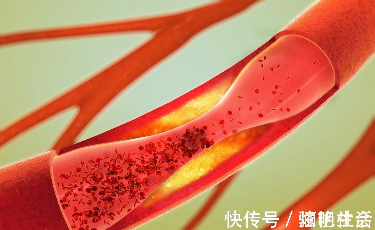 疏通血管|大蒜换种吃法,年到80都无血栓,但有一害,危害还不小