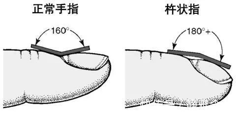 戒烟|肺不好,鼻先知,远离“3个字”,做好5件事,肺会一天比一天强壮