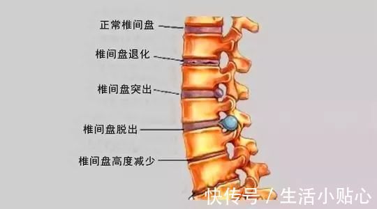 神经根|腰椎盘突出疼痛、麻木,想要缓解不适建议你试试以下6种方法