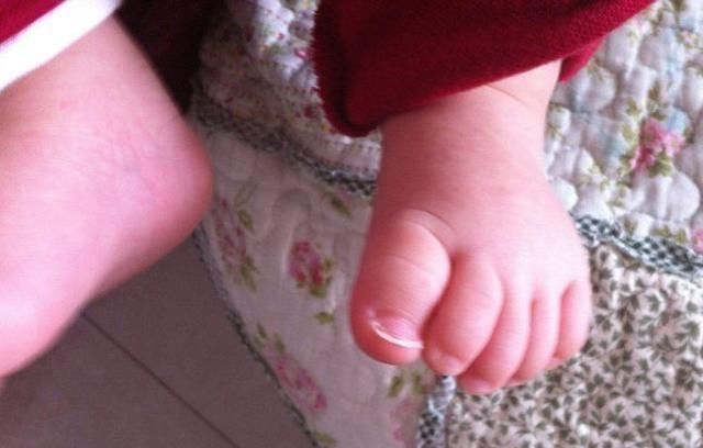 双脚|6岁孩子双脚变“畸形”,只因妈妈错误穿鞋方式,家长要引起重视