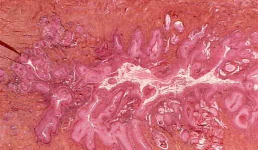 hpv|宫颈癌多是拖出来的4类女人更容易被盯上，尽早查HPV