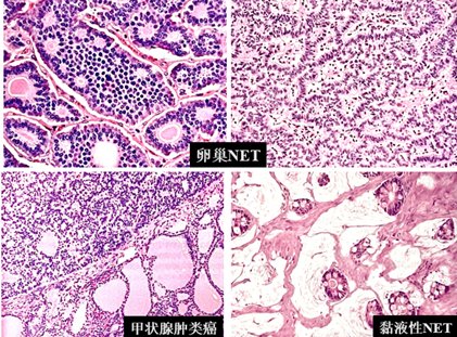 副神经节瘤|「其他部位神经内分泌肿瘤」学习笔记