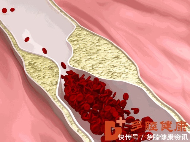 过滤器|高血脂治疗新手段——双重血液净化疗法