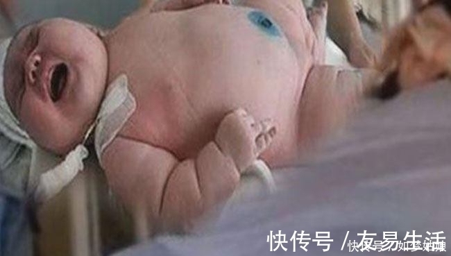 医生|六百斤孕妈生产，接生医生看到生下的孩子后，瞬间惊出冷汗！