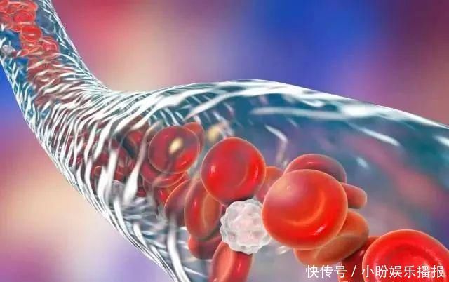 血管堵塞|血脂超标的人,鸡蛋可以吃,但这几类食物,请停止食用,切莫贪嘴