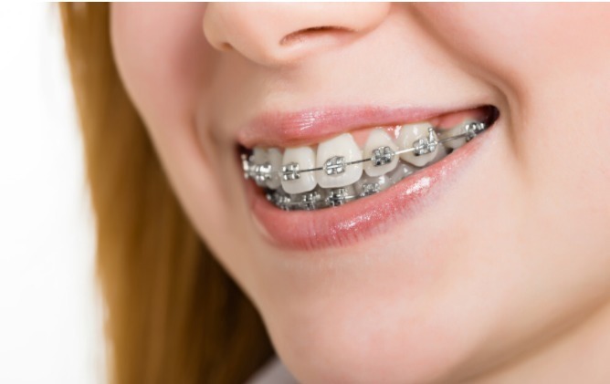 黄金期|孩子牙齿矫正,必须要12岁以后吗?你是否错过了孩子的矫正黄金期