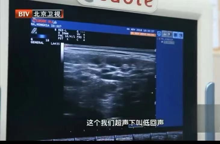 血流|2年没复查，息肉变成癌！B超报告里出现“这些字眼”可能就危险了，别等严重时才后悔