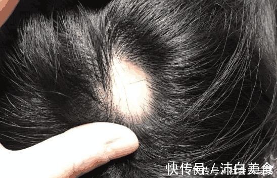 妈妈|医生提醒妈妈们给孩子扎辫子时不可用力过猛，会患上脱发类疾病！