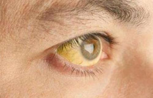 40歲主婦查出肝病,3個(gè)月離世,醫(yī)生感嘆:1種零食是最終禍根!