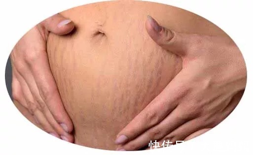 妊娠纹|【孕期】如何预防妊娠纹?