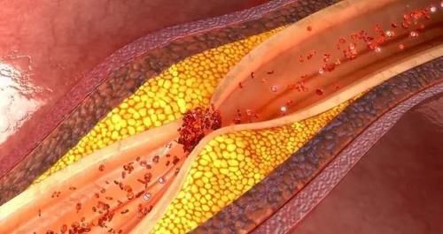 龙眼|给血脂高的人一个劝告：夏天少碰3种水果，否则血脂超标血管拥堵