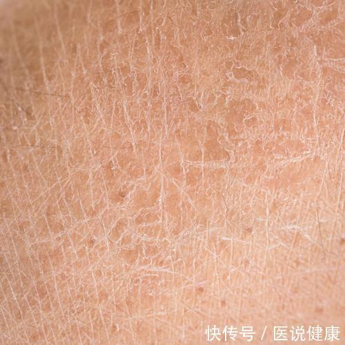 皮肤|糖尿病患者,可能会出现6种皮肤病变,发现后,及时控制血糖