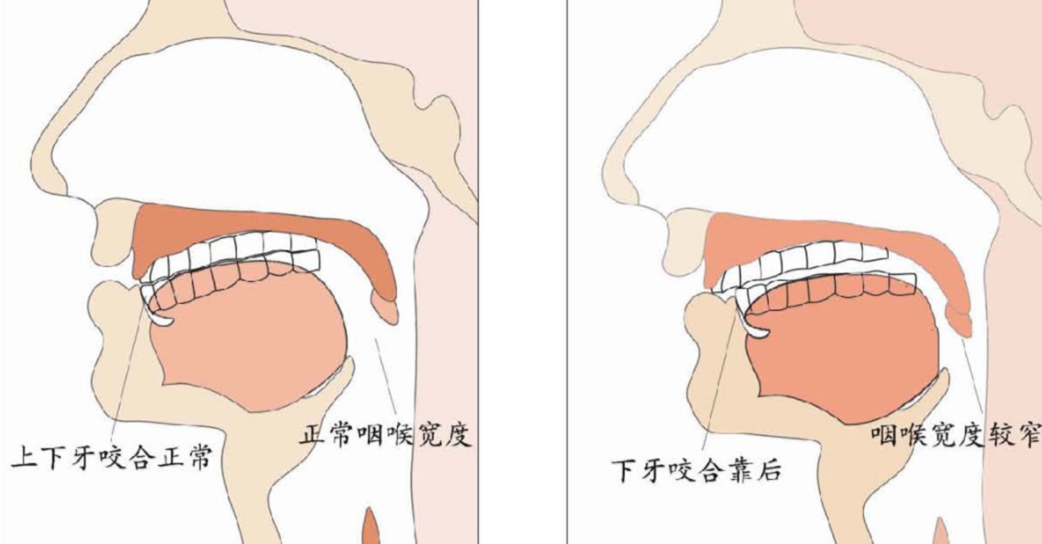 扁桃体|睡觉时一个坏习惯，会让孩子越长越丑，父母别任其发展