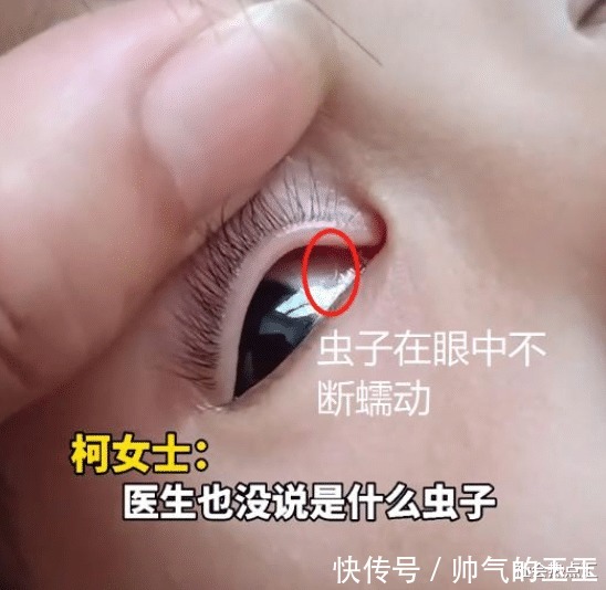 女童|2岁女童眼中取出3条白虫,妈妈误以为是眼屎,吓得不轻