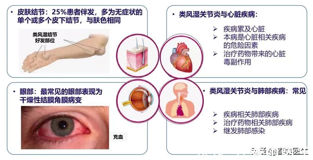 类风湿|早上起床手指僵硬疼痛？警惕类风湿找上门