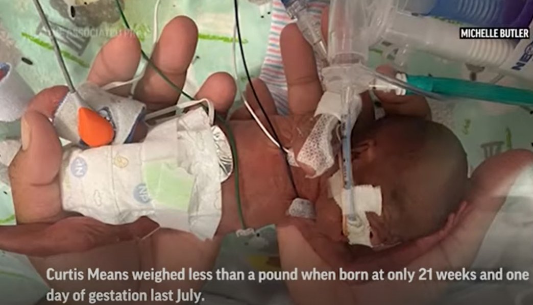 早产儿|美国一男婴刷新最早早产儿世界纪录 提前132天出生 出生仅420克