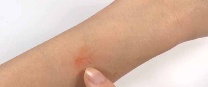 被蚊子咬了太痒难受教你一招,不用买药,快速止痒