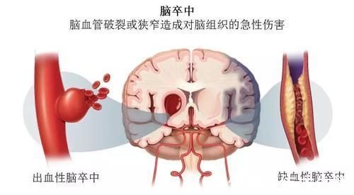 脑卒中|脑梗死预防大于治疗!医生坦言:注意几点就可轻松预防