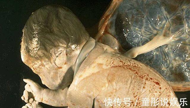 冷汗|生二胎吝啬产检费,7个月B超单一出,脸白了,惊出一身冷汗!