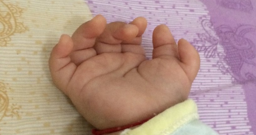 侏儒症|产检一切正常的新生儿多一个手指,爸爸要求医院赔偿,医生表示很冤枉