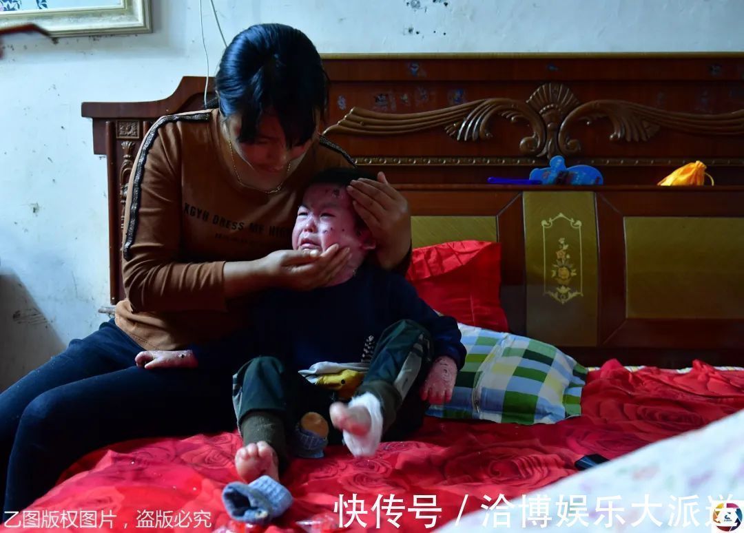 纱布|男童出生患罕见病,三年用掉纱布5000多圈,每天只能坐在床上
