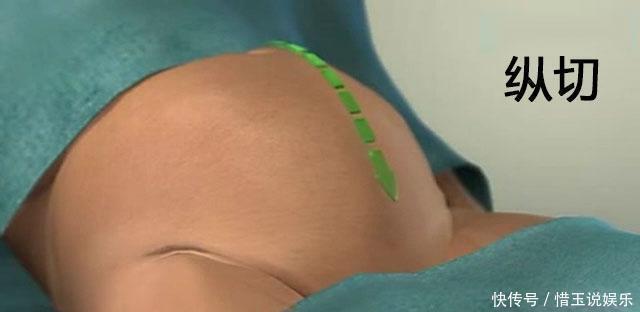 十月怀胎|生孩子剖腹产时横切和纵切哪个好好多人都选错了