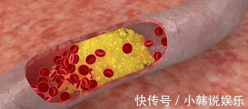 心脑血管|胆固醇偏高的人,6种食物每天吃点,胆固醇很快就降