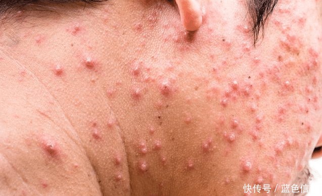 房间|房间饱受螨虫困扰只用3滴油，螨虫“铲草除根”，不花1毛钱！