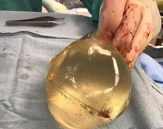 隆胸硅胶假体还能防弹一女子枪口下幸存,医生看完一脸懵