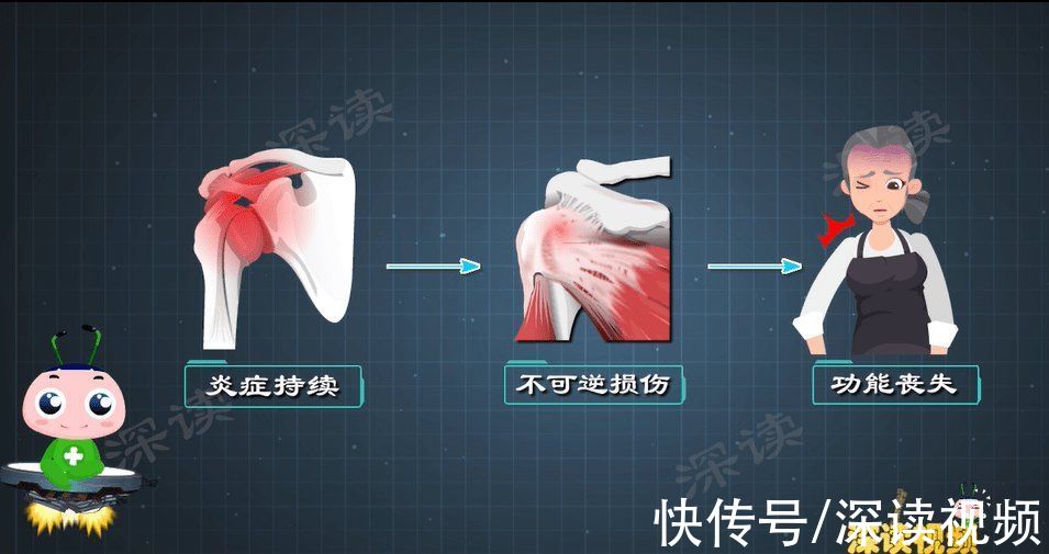 缓解期|熬夜吃鸡肩膀疼，泡妞不敢搂搂抱抱举高高，你是不是有肩周炎啊？