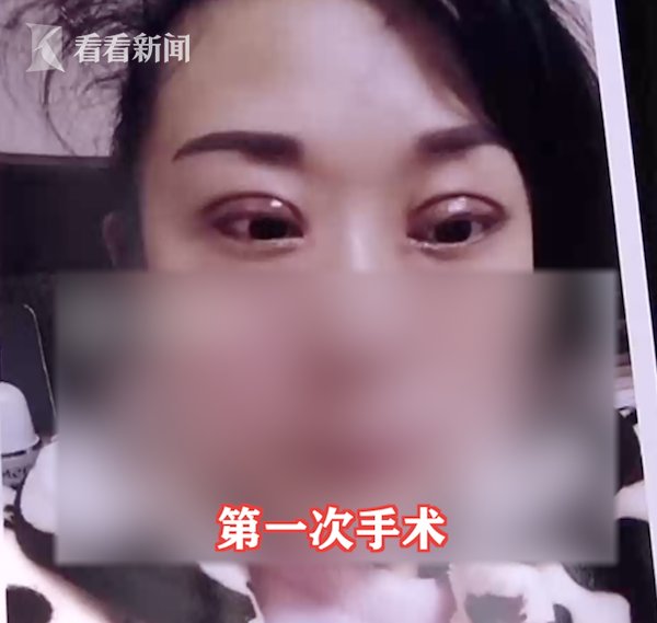 金女士|女子花2万割双眼皮3个月没消肿 老公要离婚