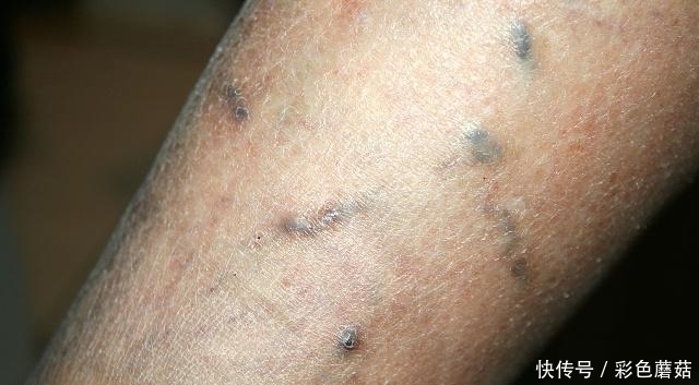 焕然一新|绝大多数“血栓”都无迹象,要想预防,记住一个字,血管焕然一新