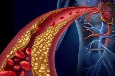 高脂蛋白血症|有7种表现可能血脂高了,医生提醒7项措施做好,保证血管顺畅
