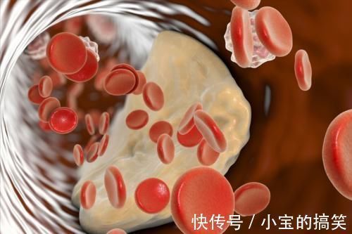 疾病|肺癌最可怕的不是疾病本身，而是伴随的并发症