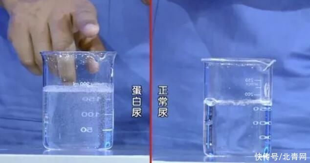 尿毒症|每10人就有一个慢性肾病,日常6大因素太伤肾