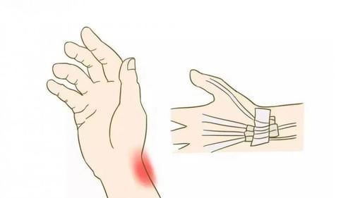 新手妈妈|提重物、抱孩子,手腕疼痛难忍?警惕,小心已患上“妈妈手”!